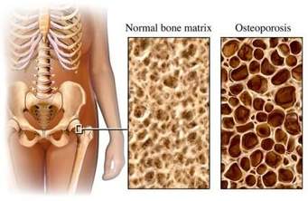 Prevenzione osteoporosi